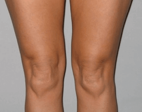 I treated knee osteoarthritis with Artovitel gel