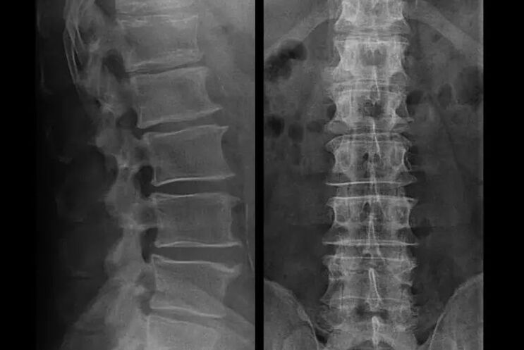 X-ray osteochondrosis