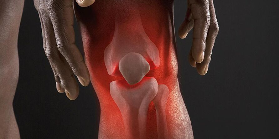 Burning sensation in the knee area is a symptom of gonarthrosis